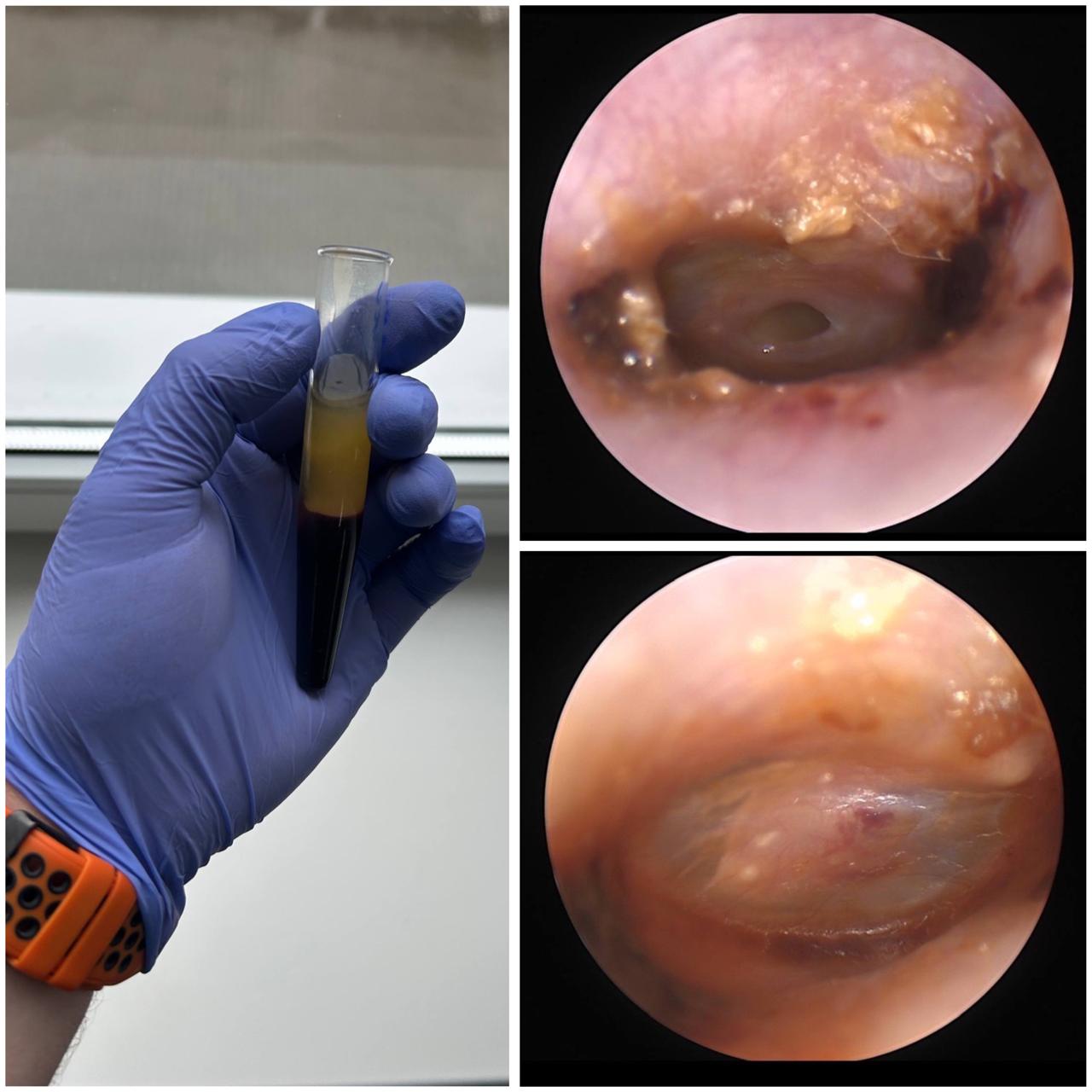 Пошкодження барабанної перетинки